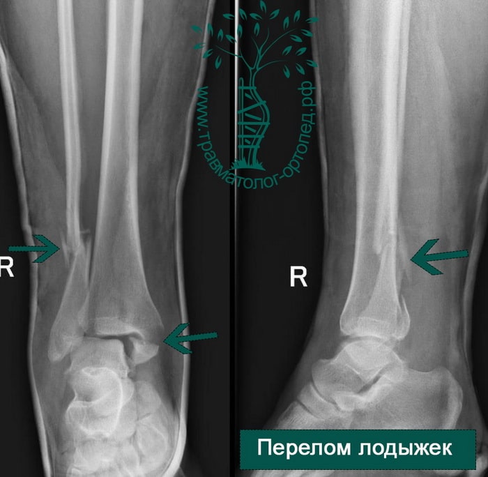 Реферат: Лечение переломов лодыжек с отрывом заднего нижнего края большеберцовой кости